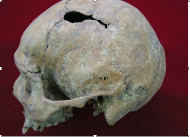 Anadolu’nun ilk (beyin) cerrahları